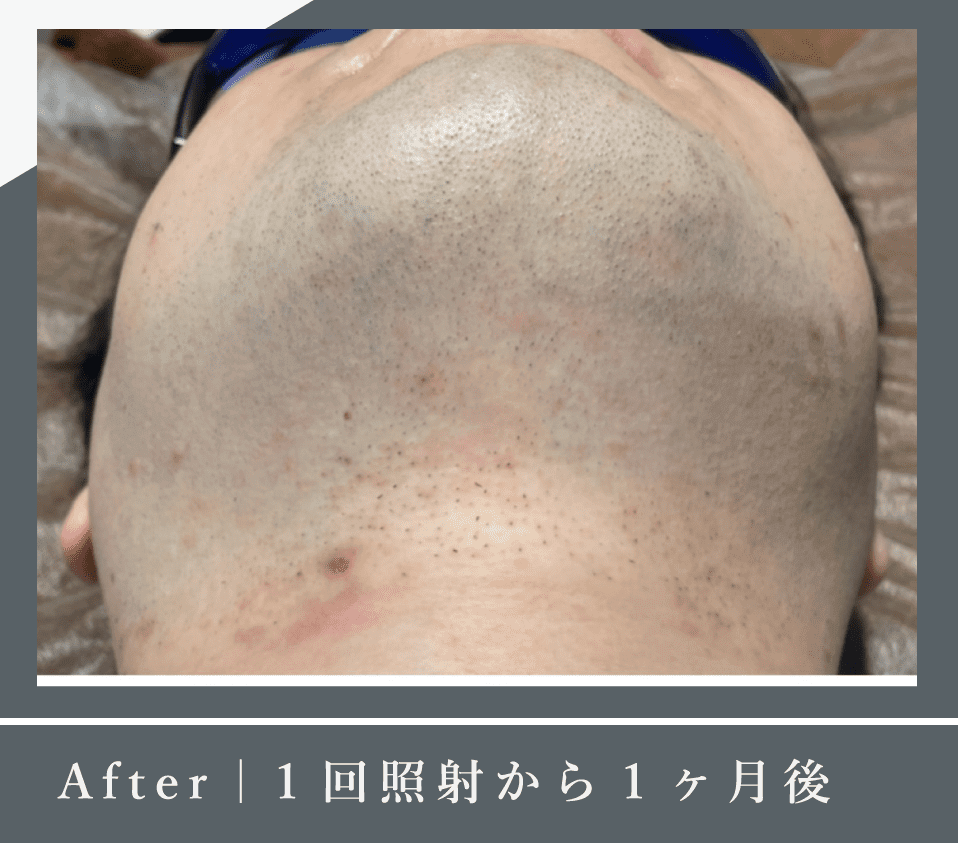 After｜1回照射から1ヶ月後