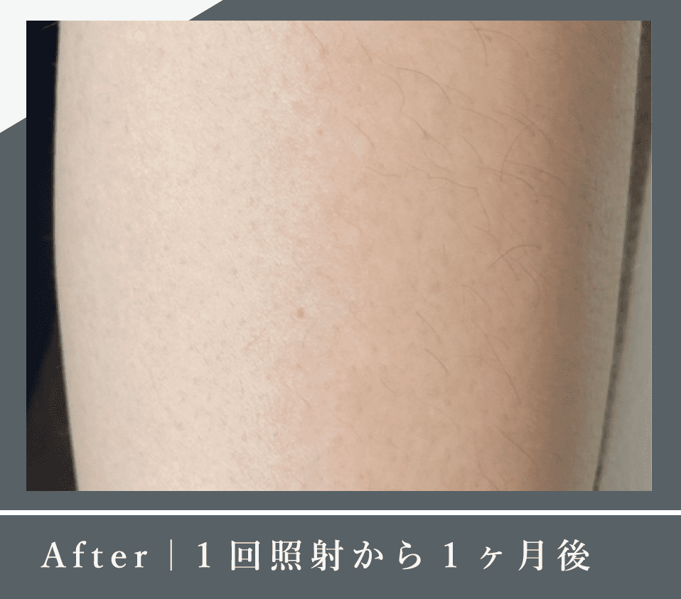 After｜1回照射から1ヶ月後