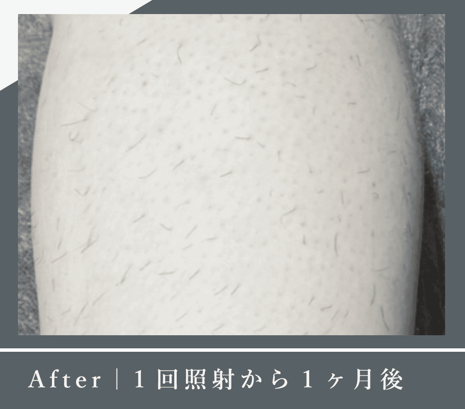 After｜1回照射から1ヶ月後